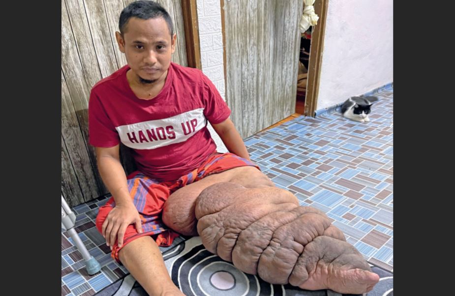 15 tahun hidup menderita kaki membesar akibat penyakit kaki gajah, pemuda pasrah kemungkinan tiada jodoh